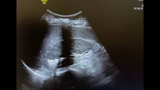 Ultrasound of emphysematous pyelonephritis [upl. by Mccandless]