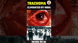 Trachoma Eliminated by India shorts [upl. by Adnim175]