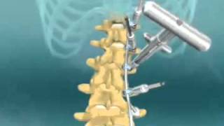 Scoliosis Spinal Fusion Animation [upl. by Rodina]