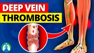 Deep Vein Thrombosis DVT  Quick Medical Overview [upl. by Rajiv476]