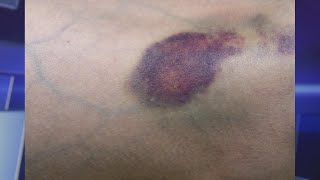 Do You Bruise Easily Learn How to Prevent and Fade Them [upl. by Cirdor]