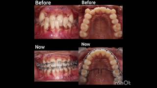 Progress in orthodontic treatment [upl. by Ck]