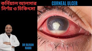 Corneal Ulcer Diagnosis amp Treatment 🔴 কর্নিয়াল আলসার নির্ণয় ও চিকিৎসা  চোখের কর্নিয়ার রোগ [upl. by Nady288]