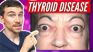 7 Signs of Thyroid Eye Disease and Graves Disease [upl. by Alin]