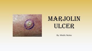 Marjolin ulcer  causes risk factors signs and symptoms treatment prognosis [upl. by Lechner142]