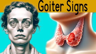 Goiter explained under 3 minutes Causes Symptoms Treatment [upl. by Mayberry]