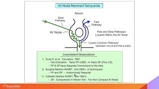 Complex Cases Simplified AVNRT Part I with Warren quotSonnyquot Jackman MD [upl. by Annaeerb]