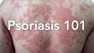 EVERYTHING to Know About Psoriasis  Dermatologist Explains [upl. by Moretta648]