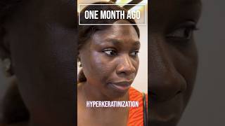 Meet Ms Adeola 🤩✨ who tackled HyperMelanosis with our Hyperpigmentation Treatment Protocol HTP✨ [upl. by Haukom]