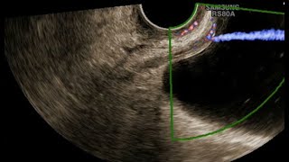 Gynecological ultrasound exam Beyond uterus and ovaries [upl. by Spillihp]