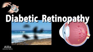 Retinopathy Diabetic and Hypertensive Animation [upl. by Olifoet828]