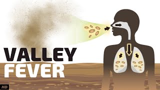 Valley Fever Causes Signs and Symptoms Diagnosis and Treatment [upl. by Alak413]