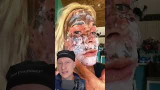 SHOCKING CO2 Laser Recovery Is Normal  Plastic Surgeon Reacts [upl. by Htinek]