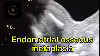 Endometrial osseous metaplasia [upl. by Salvador984]