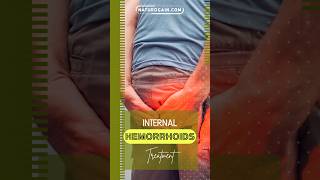 Healing Internal Hemorrhoids Effectively 🌿✨ Your Comprehensive Guide shortsvideo [upl. by Kire553]