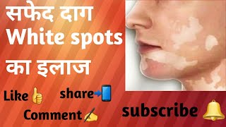 Leucoderma white spots सफेद दागफूल रोग Sure shot treatment [upl. by Nycila]