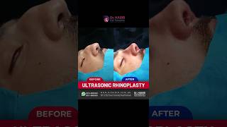 Transformative Rhinoplasty Before and After  Expert Nose Job Results [upl. by Ahsrats]