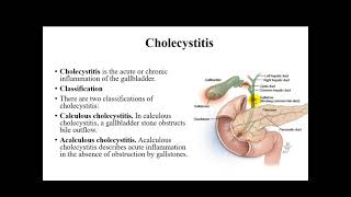 management of cholecystitis and cholelithiasis [upl. by Sillad]