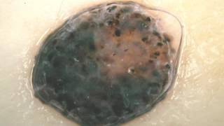 MELANOMA NODULAR  Dra Carolina Marcucci [upl. by Oetomit]