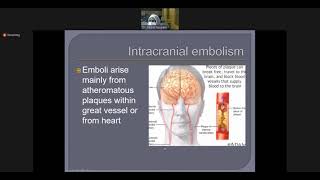 Approach to Pediatric Stroke  Pediatrics [upl. by Eedak]