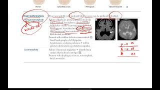 Neural tube defects Brain malformations  Neurology  2  First Aid USMLE Step 1 [upl. by Ajidahk]