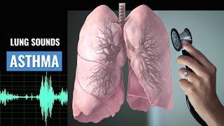 Asthma Lung sound  Wheezing  Asthma  Christina NP  Caring Casa [upl. by Airegin]