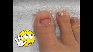 No TOENAILS  Make Some  Acrylic Glitter Toesnails  Using Dual Forms [upl. by Sturges955]