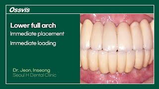 Clinical Case Lower full arch immediate placement amp loading [upl. by Tavey995]