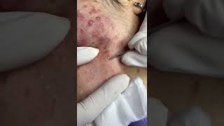 Best Pimple Popping 08 beautiful blackheads sacdepspa [upl. by Akinajnat]