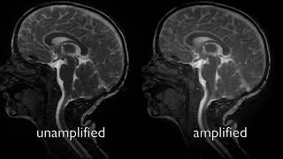 aMRI Video of Chiari Malformation I Patient [upl. by Beltran501]