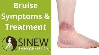 Bruise Symptoms and Treatment [upl. by Jaclin]