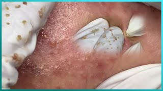 Big Cystic Acne Blackheads Extraction Blackheads amp Milia Whiteheads Removal Pimple Popping [upl. by Neelia]