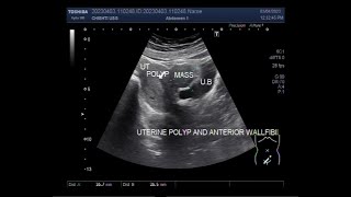 Uterine Polyp with Fibroid on Ultrasound [upl. by Annanhoj949]