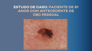 NEVO COMPOSTO BENIGNO ou MELANOMA em paciente de 81 anos 0 Dermatoscopia  Lesão origem melanocítica [upl. by Tisdale]