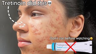 Tretinoin mistakes that ruined my skin 😫 tretinoin skincare beauty [upl. by Naman347]