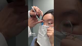 Fitting A Scleral Lens With Eyeprint Pro keratoconus eyedoctor dryeyes contactlenses [upl. by Neirol]