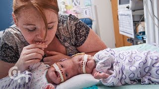 Conjoined Twins Abby and Erin Delaney A Year in the Life [upl. by Eillib448]