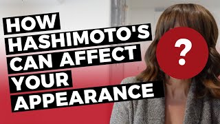 HASHIMOTOS DISEASE SYMPTOMS How it affects my appearance [upl. by Hole]