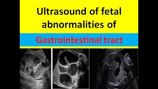 Ultrasound diagnosis of fetal anomalies of GIT [upl. by Nierman]