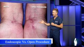 Carpal Tunnel Release  Open Procedure vs Endoscopic [upl. by Jezreel]