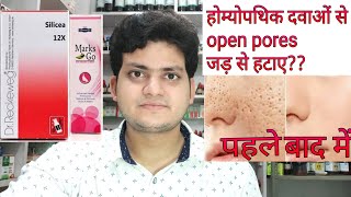 How to remove open pores of face permanently by Homeopathic medicine Explain [upl. by O'Kelly]