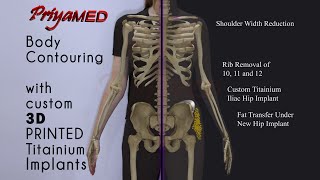 PriyaMED presents A New CURVY you  ShouldersRibsHipsFat Transfer [upl. by Ergener]