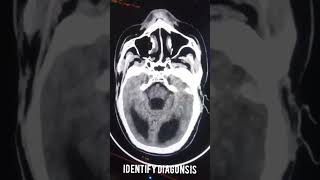 Ct scan Head hydrocephalus [upl. by Atiuqin155]