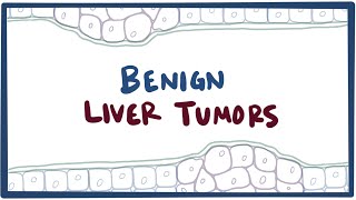 Benign liver tumors  causes symptoms diagnosis treatment amp pathology [upl. by Irab935]