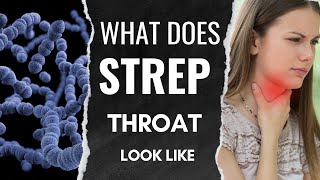 Understanding Strep Throat What it Looks Like and How to Identify Symptoms [upl. by Gelb676]