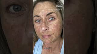 Melasma Can Be Cured With Hydroquinone Dermatologist Explains [upl. by Randene5]