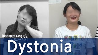 Cervical Dystonia Dystonia Spasmodic Torticollis  사경증 치료사례  근긴장이상증 [upl. by Henley365]