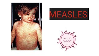 MEASLES Causes Pathology Symptoms Diagnosis Treatment Vaccination Care  What is Measles [upl. by Ellered439]