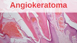 Angiokeratoma of Mibelli  Pathology mini tutorial [upl. by Nam]