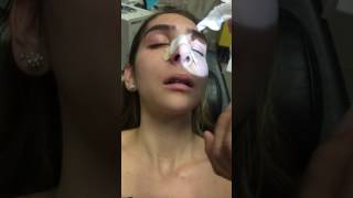 Removing a Nasal Stent 5 Days after Rhinoplasty [upl. by Helmer]